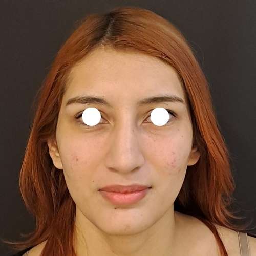 El después del Tratamiento de Eliminar Ojeras con ácido hialurónico en la clínica de medicina estetica EB en Madrid