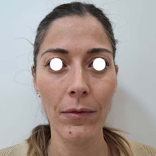 antes aumento pómulos en clinica medicina estetica EB en Madrid