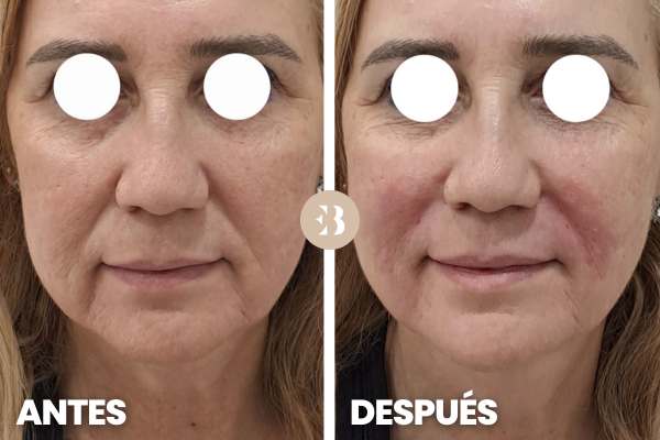 antes y después del surco nasogeniano eliminar