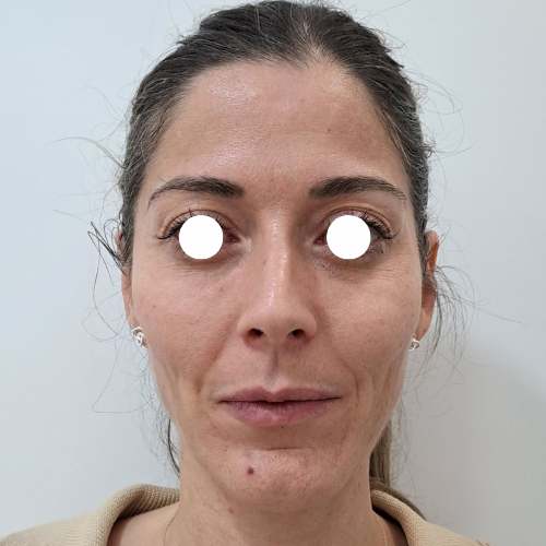 después aumento pómulos en clinica medicina estetica EB en Madrid