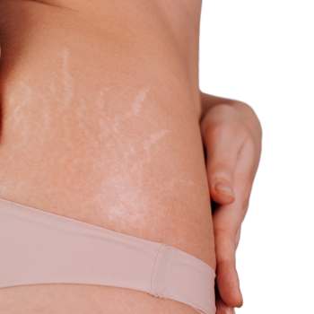 Quitar estrías. Tratamiento para eliminar las estrías en la clínica de medicina estética EB