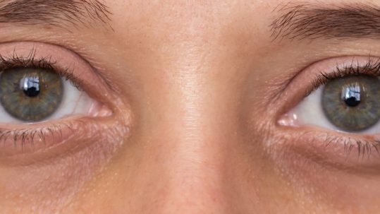 eliminar ojeras madrid acido hialuronico en la clínica de medicina estética EB en Madrid