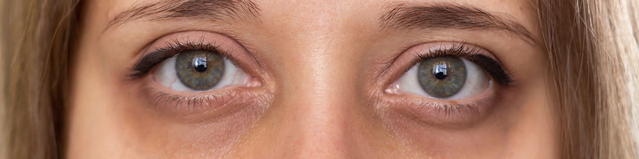 eliminar ojeras madrid acido hialuronico en la clínica de medicina estética EB en Madrid