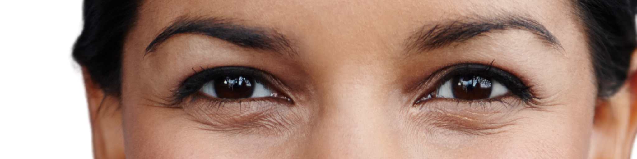 quitar ojeras con acido hialurónico