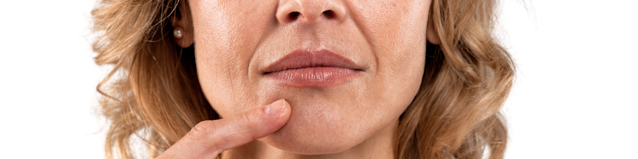 eliminar surco nasogeniano precio en madrid