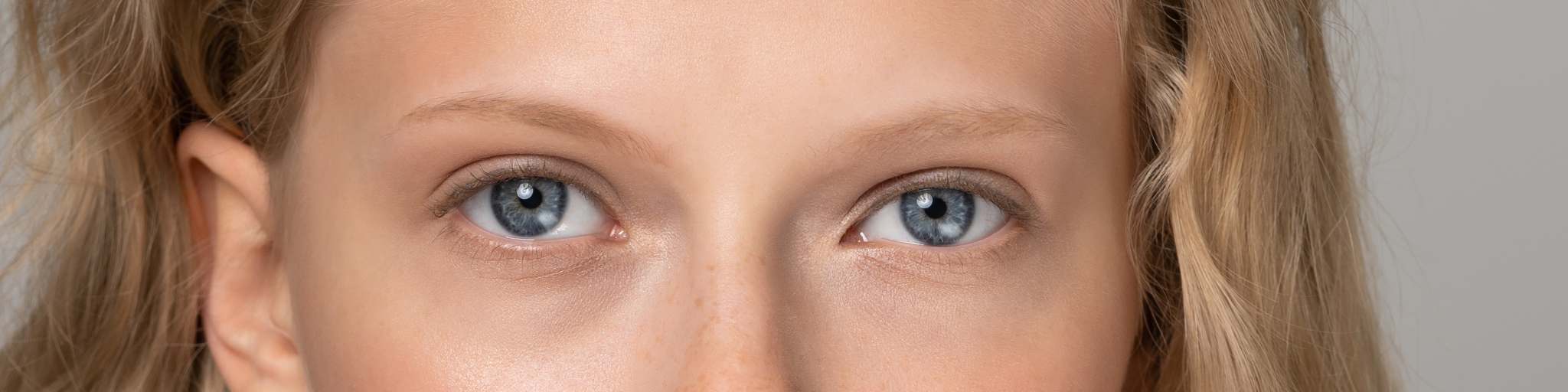 antes y después acido hialuronico en ojeras