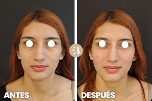 antes y después del acido hialurónico en ojeras. Tratamiento de relleno de ojeras