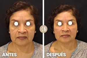 antes y después del acido hialurónico en ojeras. Tratamiento de relleno de ojeras