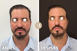 antes y después del acido hialurónico en ojeras. Tratamiento de relleno de ojeras