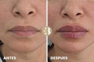 Antes y después del aumento de labios con acido hialuronico en Clinica de Medicina estetica EB en Madrid