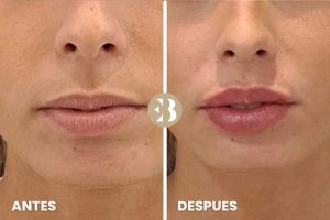 Antes y después del aumento de labios con acido hialuronico en Clinica de Medicina estetica EB en Madrid