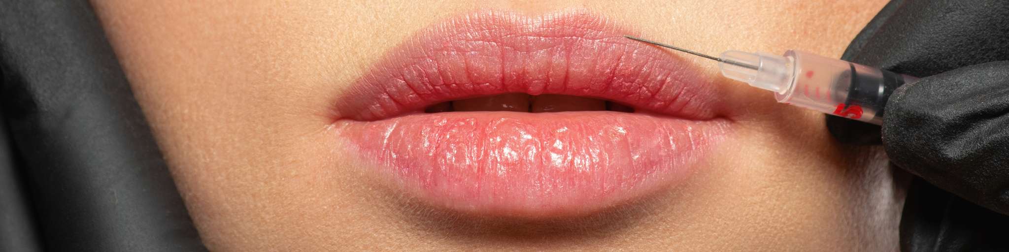 aumento labios con acido hialuronico