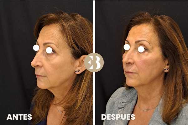 Aumento de pómulos antes y después en la Clinica de Medicina Estética EB en Madrid
