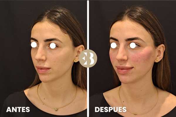 Aumento de pómulos antes y después en la Clinica de Medicina Estética EB en Madrid