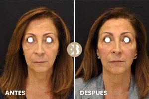 Aumento de pómulos antes y después en la Clinica de Medicina Estética EB en Madrid