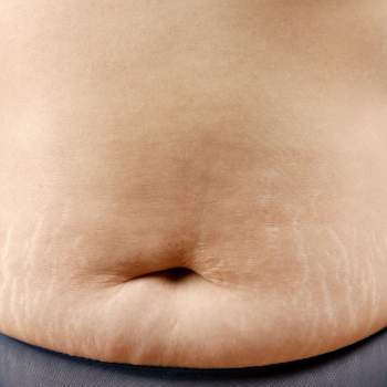 Eliminar estrías en Madrid con el tratamiento laser Lumenis M22