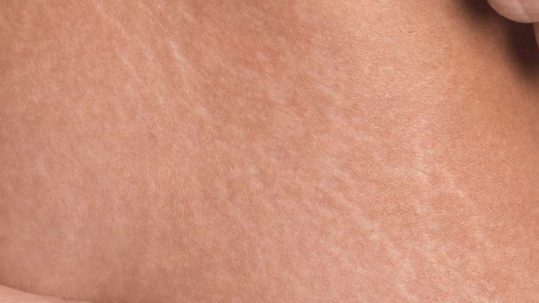 Eliminar estrías con el tratamiento laser Lumenis M22 en la clinica de Medicina estetica EB