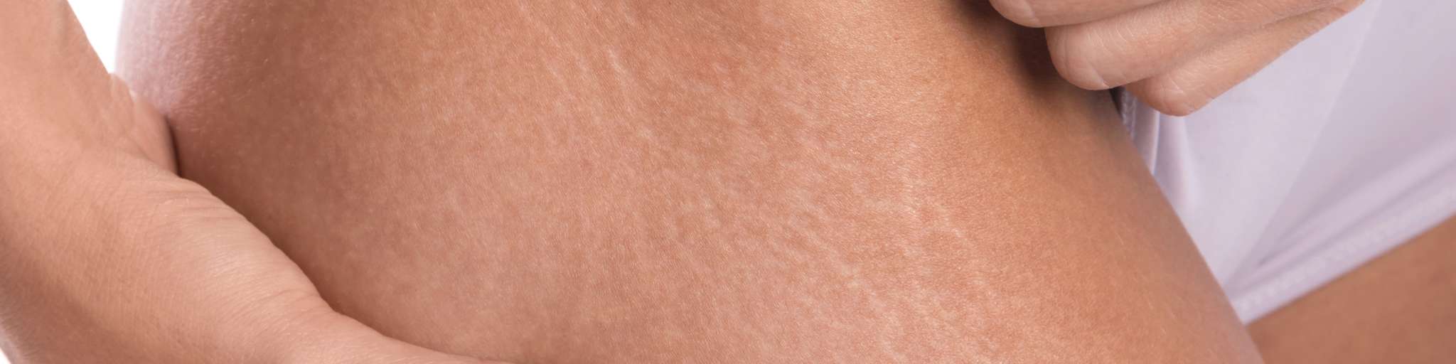 Eliminar estrías con el tratamiento laser Lumenis M22 en la clinica de Medicina estetica EB