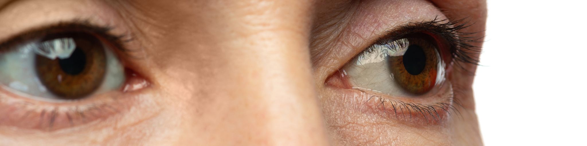 Eliminar ojeras en Madrid. Qué causa las bolsas y ojeras. Clinica de Medicina Estetica EB