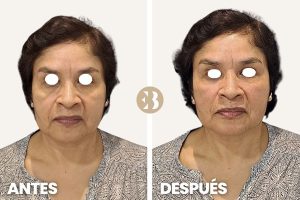 Antes y después arrugas ojos