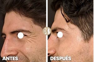Antes y después arrugas ojos