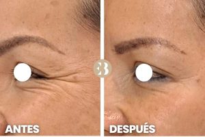 Antes y después arrugas ojos