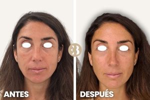 Antes y después arrugas ojos