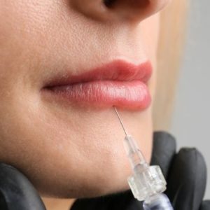 perfilado y relleno de labios en la clinica de medicina estetica EB en Madrid