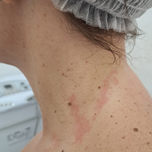 antes quitar manchas piel