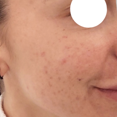 antes del tratamiento de resurfacing. Laser Facial