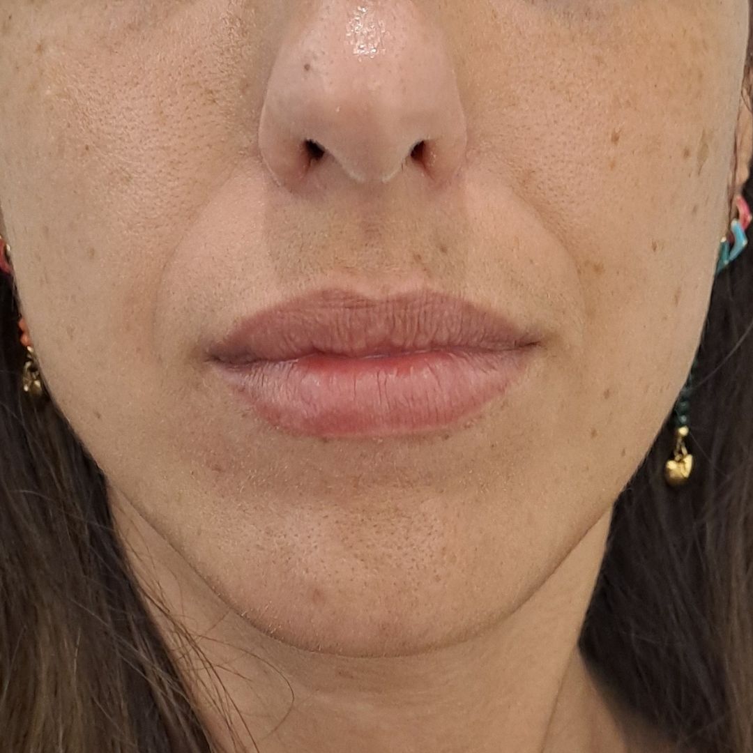 antes aumento de labios madrid