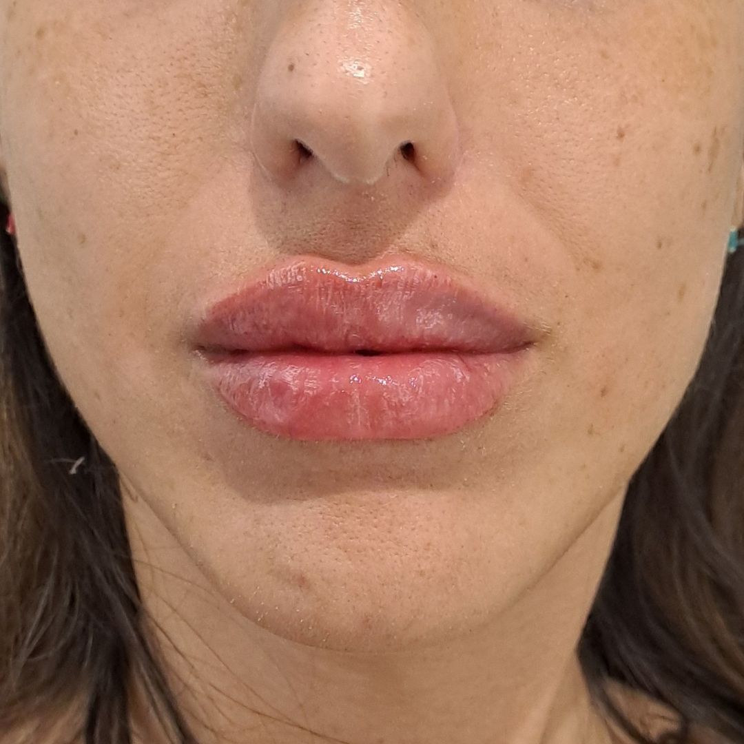 aumento de labios Madrid después