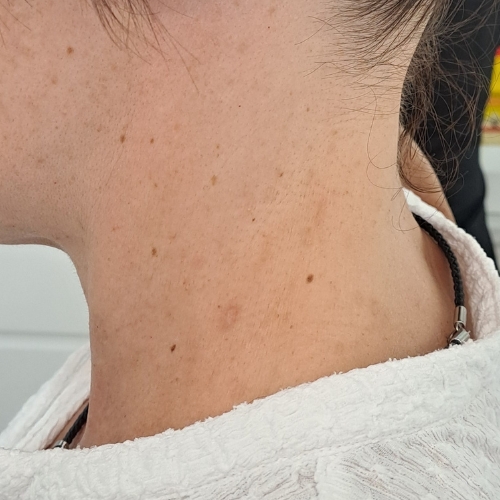 Después de quitar manchas piel- Laser Lumenis M22