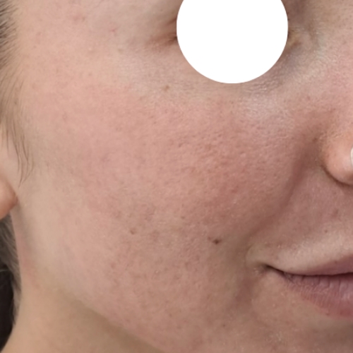 Después del tratamiento de resurfacing. Laser Facial