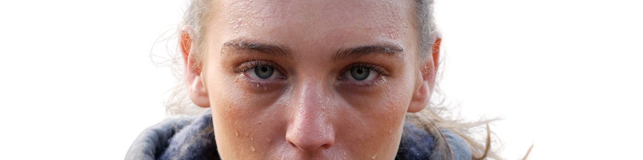 hiperhidrosis facial tratamiento con botox