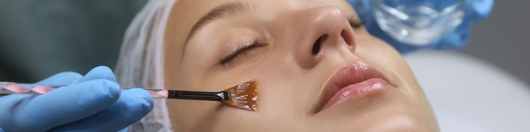 Peeling fenol en Madrid. Tratamiento de Peeling Químico en la Clinica de Medicina Estetica EB