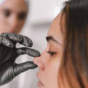 rinomodelacion con acido hialuronico-madrid en la Clinica de medicina Estetica EB