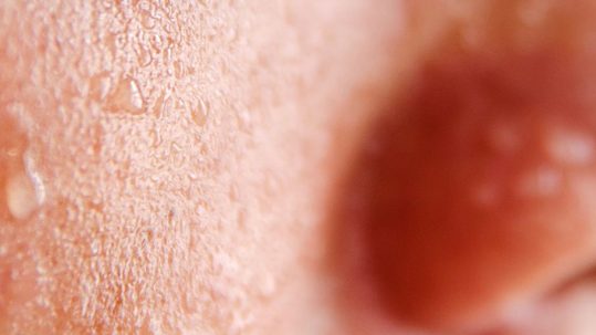 sudoracion intensa hiperdrosis botox