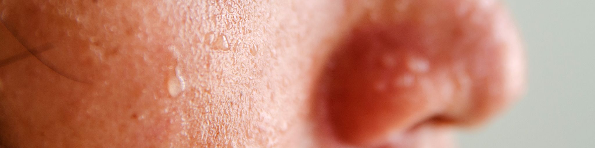 sudoracion intensa hiperdrosis botox