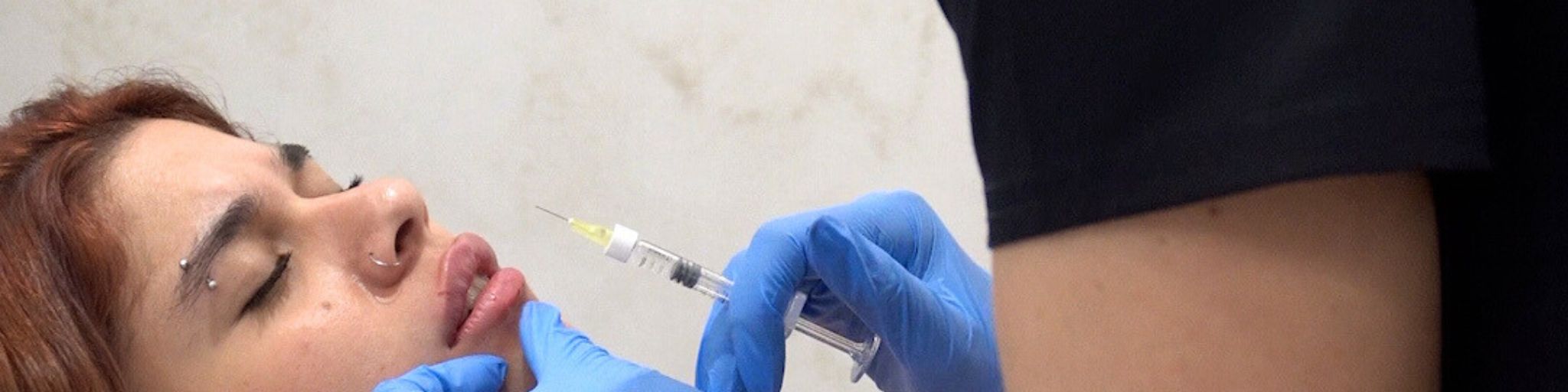 acido hialurónico labios cuidados tras el tratamiento