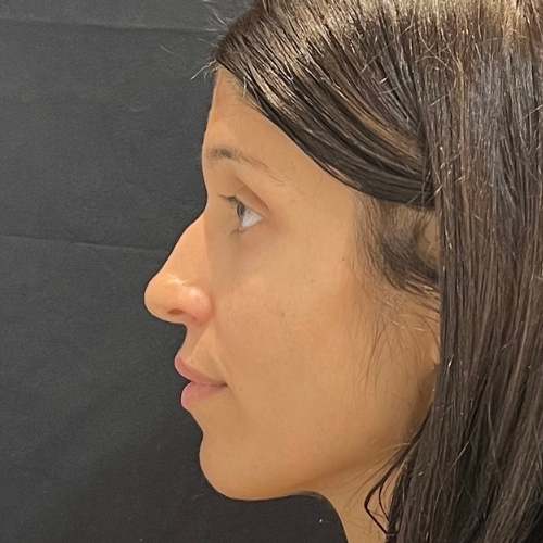 antes de la rinomodelación en Clinica Medicina Estetica Eb en Madrid