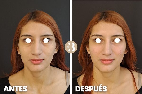 aumento de pómulos antes y después