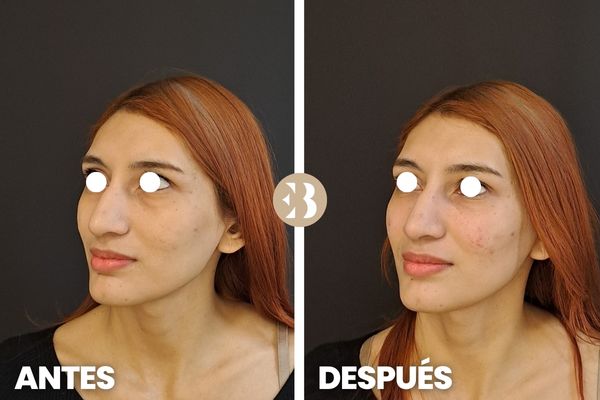 aumento de pómulos antes y después