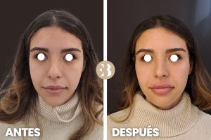 antes y después aumento de pomulos