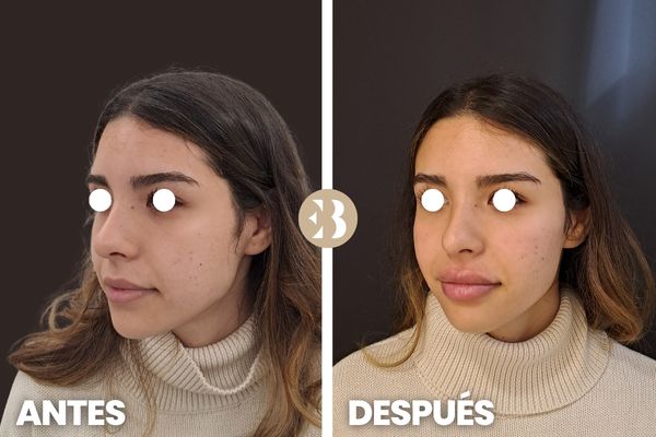 antes y después aumento de pómulos