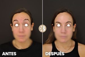 Antes y después botox Madrid. Tratamiento para quitar las arrugas frente, entrecejo y patas de gallo