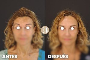 Antes y después botox Madrid. Tratamiento para quitar las arrugas frente, entrecejo y patas de gallo