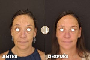 Antes y después botox Madrid. Tratamiento para quitar las arrugas frente, entrecejo y patas de gallo