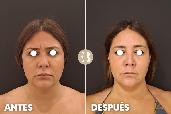Antes y después botox Madrid. Tratamiento para quitar las arrugas frente, entrecejo y patas de gallo