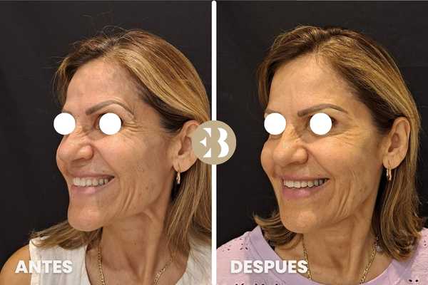 bótox antes y después patas de gallo